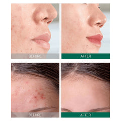 SOME BY MI AHA.BHA.PHA 30 Days Miracle Starter Kit Edition 4 Piece