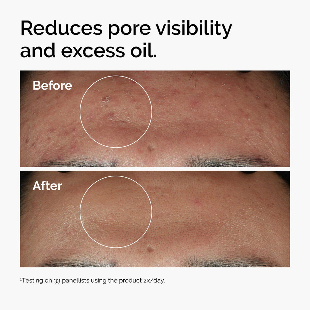 The Ordinary Niacinamide 10% + Zinc 1% serum