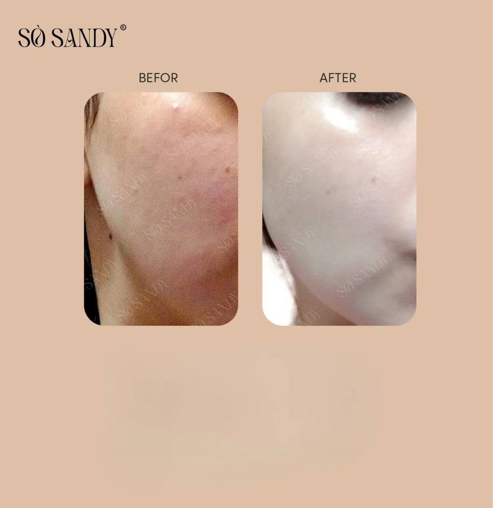 So Sandy Mela Off Cream Cold Peel 5 gm