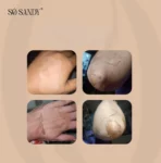 So Sandy Mela Off Cream Cold Peel 5 gm